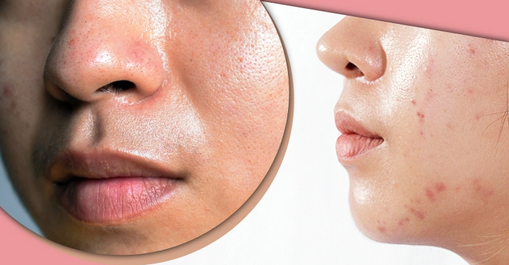 মুখের অতিরিক্ত তৈলাক্তভাব দূর করার ৫ উপায়